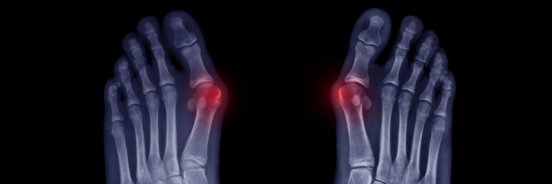 Minimally Invasive Osteotomy for Bunion Correction: Surgical Technique and Results