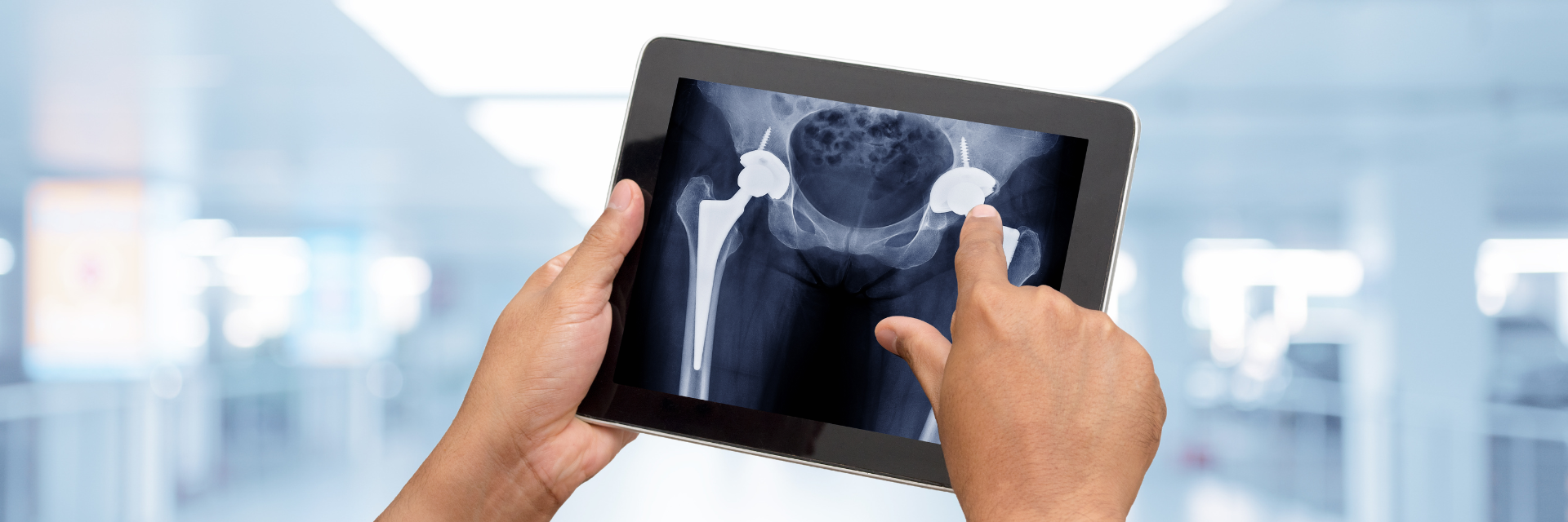 Advanced Precision in Computer-Assisted Total Hip Replacement Surgery
