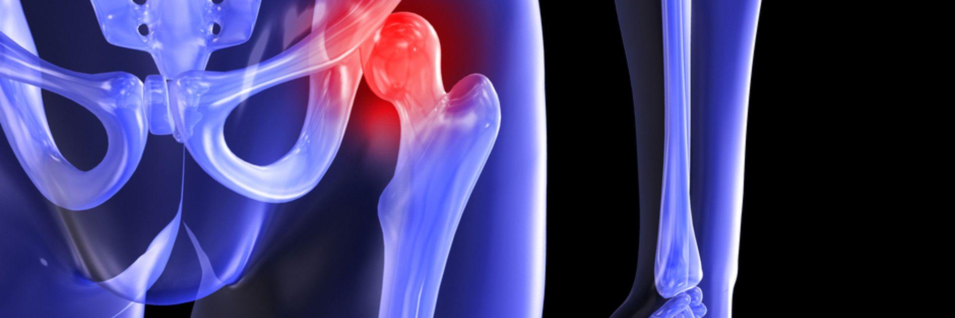 Treatments for Hip Arthritis: What’s Right For You?