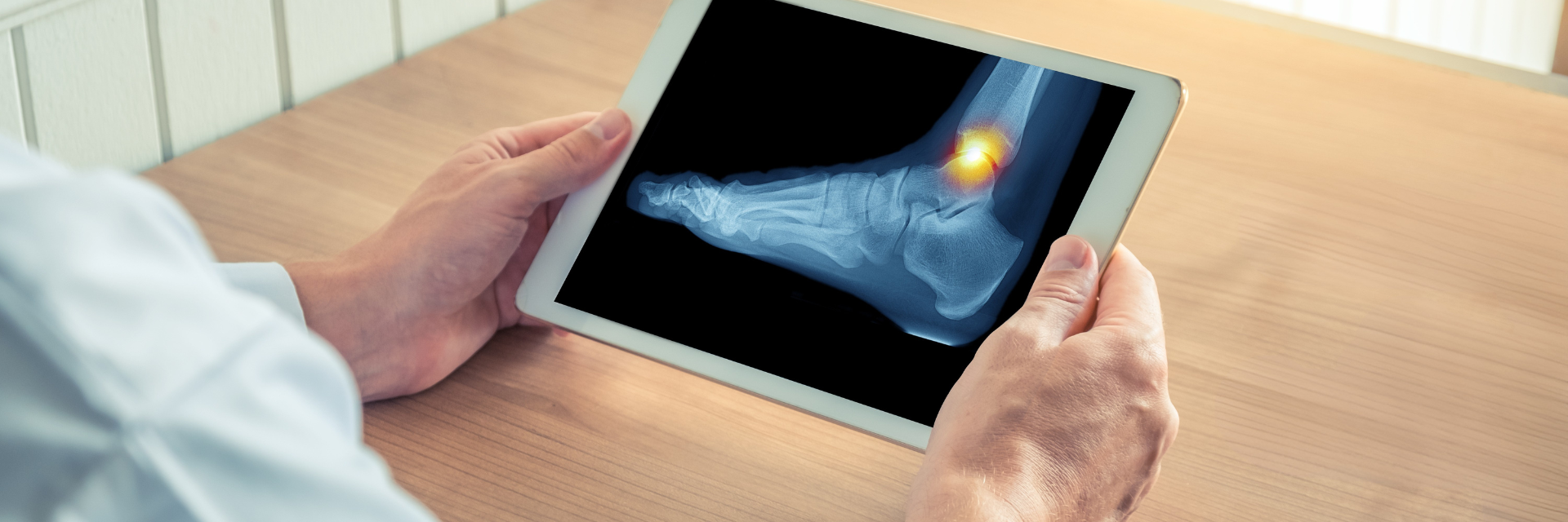 Total Ankle Replacements vs Ankle Fusion: Choosing the Right Option